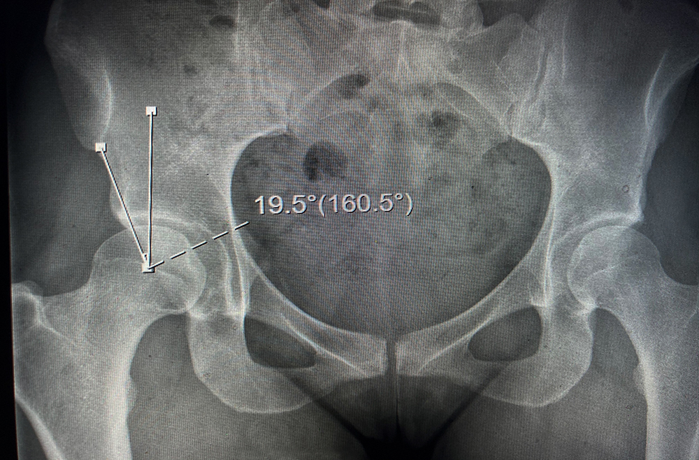 Uncorrected Dysplasia of the hip